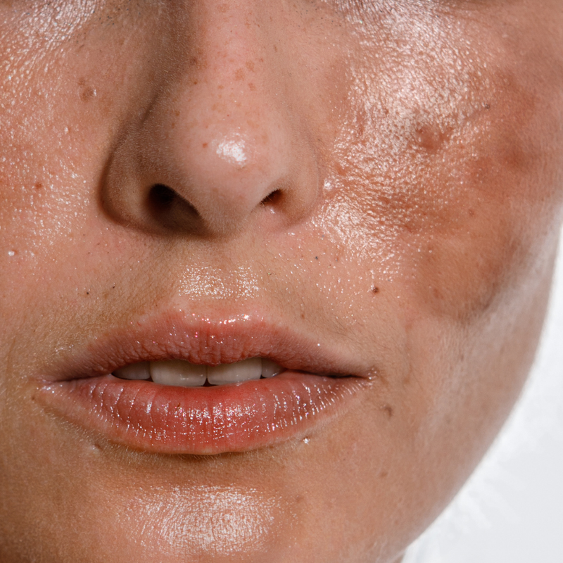 HYPERPIGMENTATION